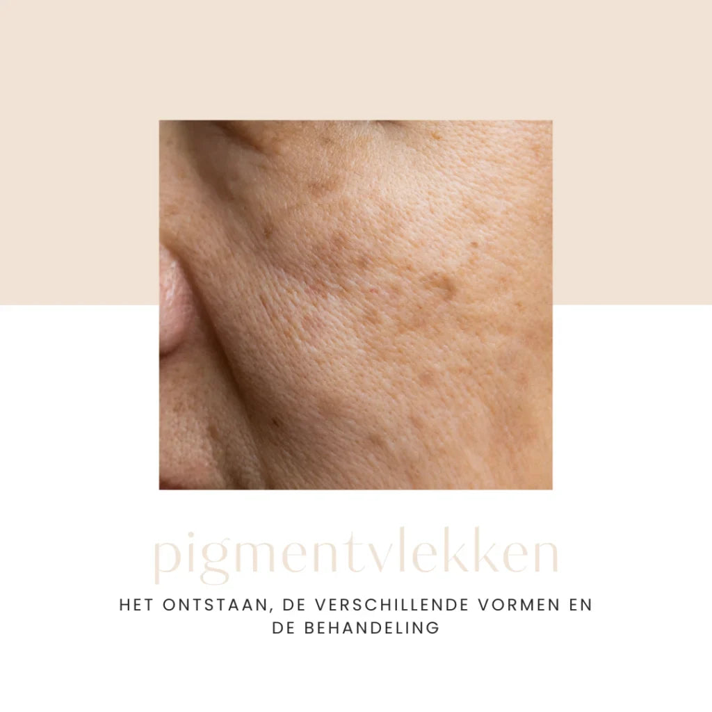 Pigmentvlekken, lees hier alles wat je wil weten