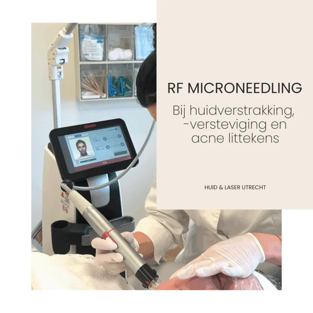 RF Microneedling voor een stevigere en strakkere huid