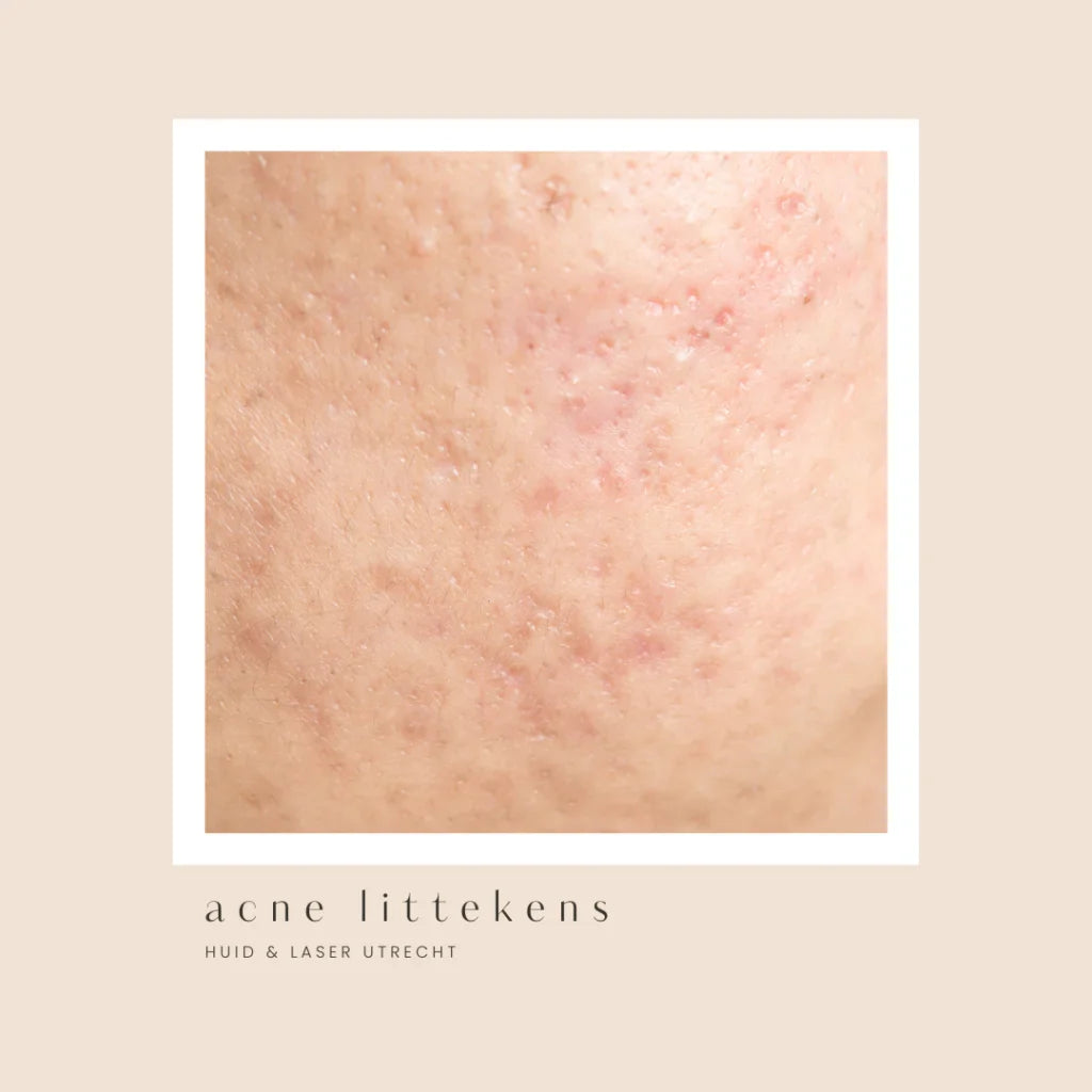 Acne Littekens Verminderen: Welke Behandelingen Zijn Het Meest Effectief?