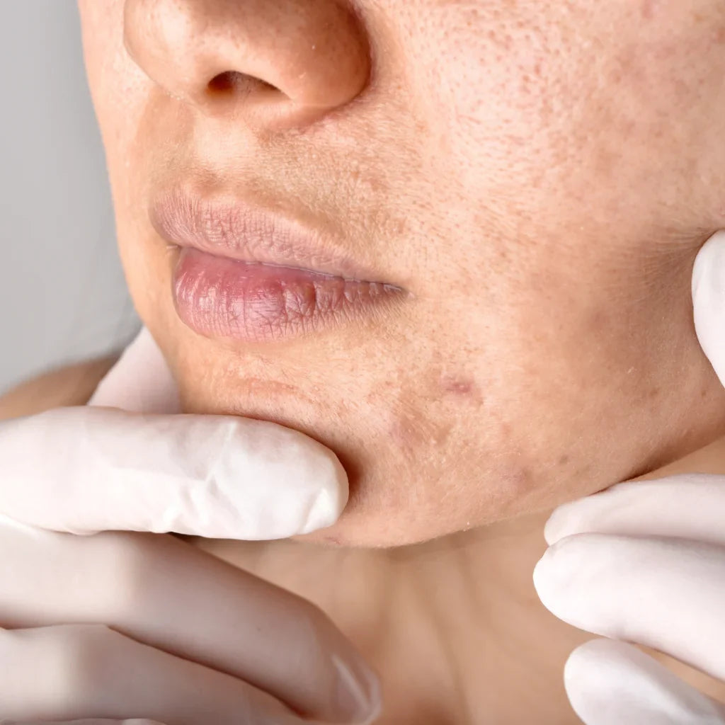 Hoe verschilt postinflammatoire hyperpigmentatie van andere huidaandoeningen?