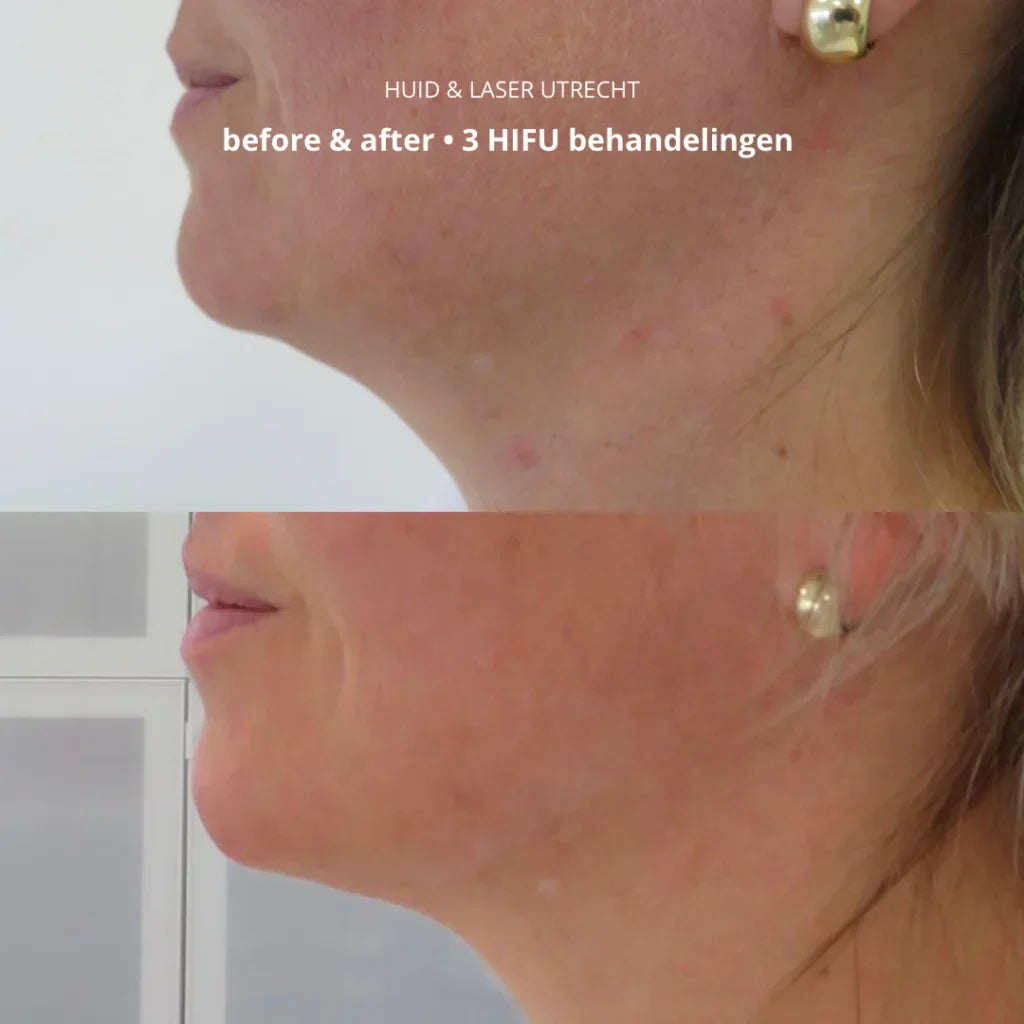 HIFU in combinatie met een fractionele laser voor het beste resultaat