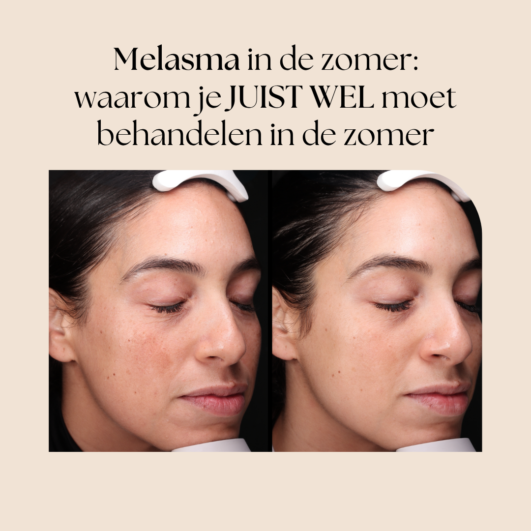 Melasma in de zomer: waarom je JUIST WEL moet behandelen in de zomer
