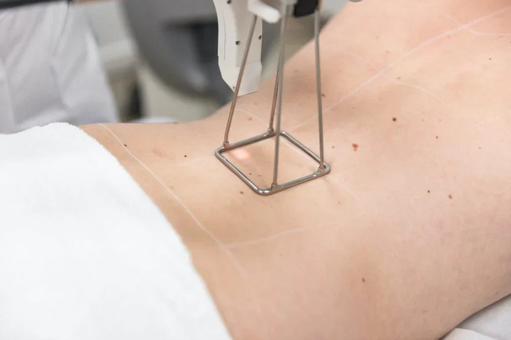 Verschil tussen IPL en laser bij ongewenste haargroei