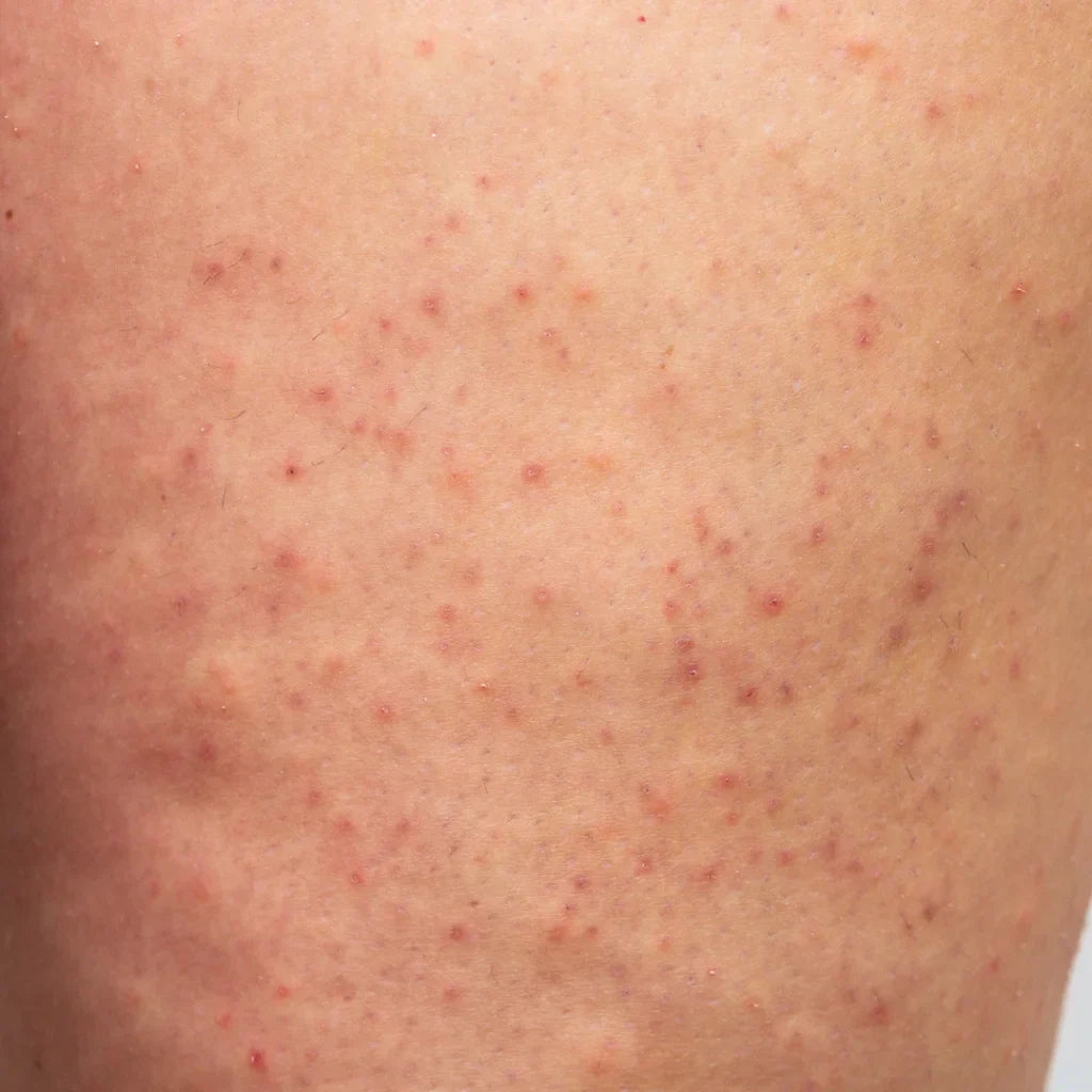 Hoe kun je Keratosis Pilaris behandelen?