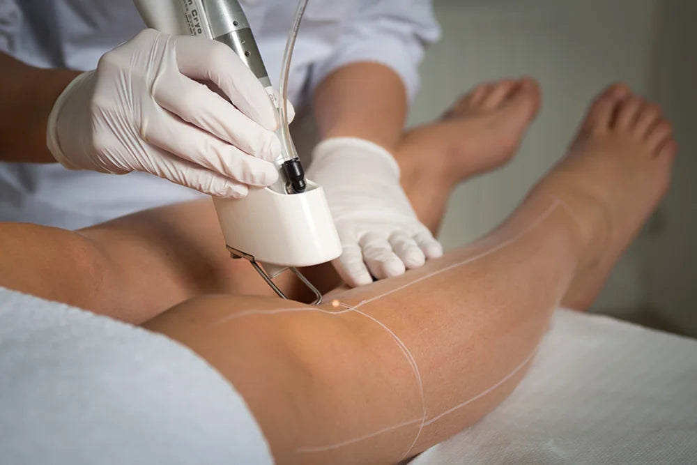 Is laserontharing veilig in de zomer?