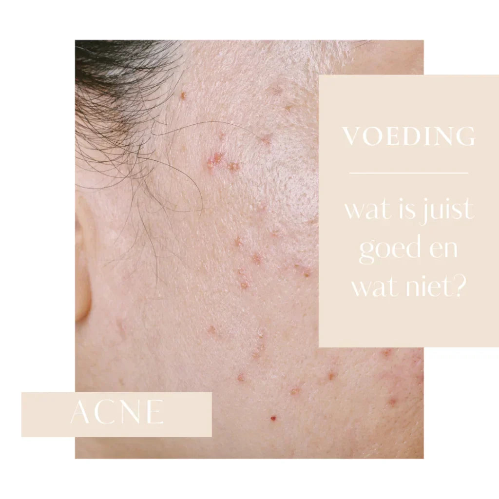 Voeding en Acne: Wat helpt en wat niet?