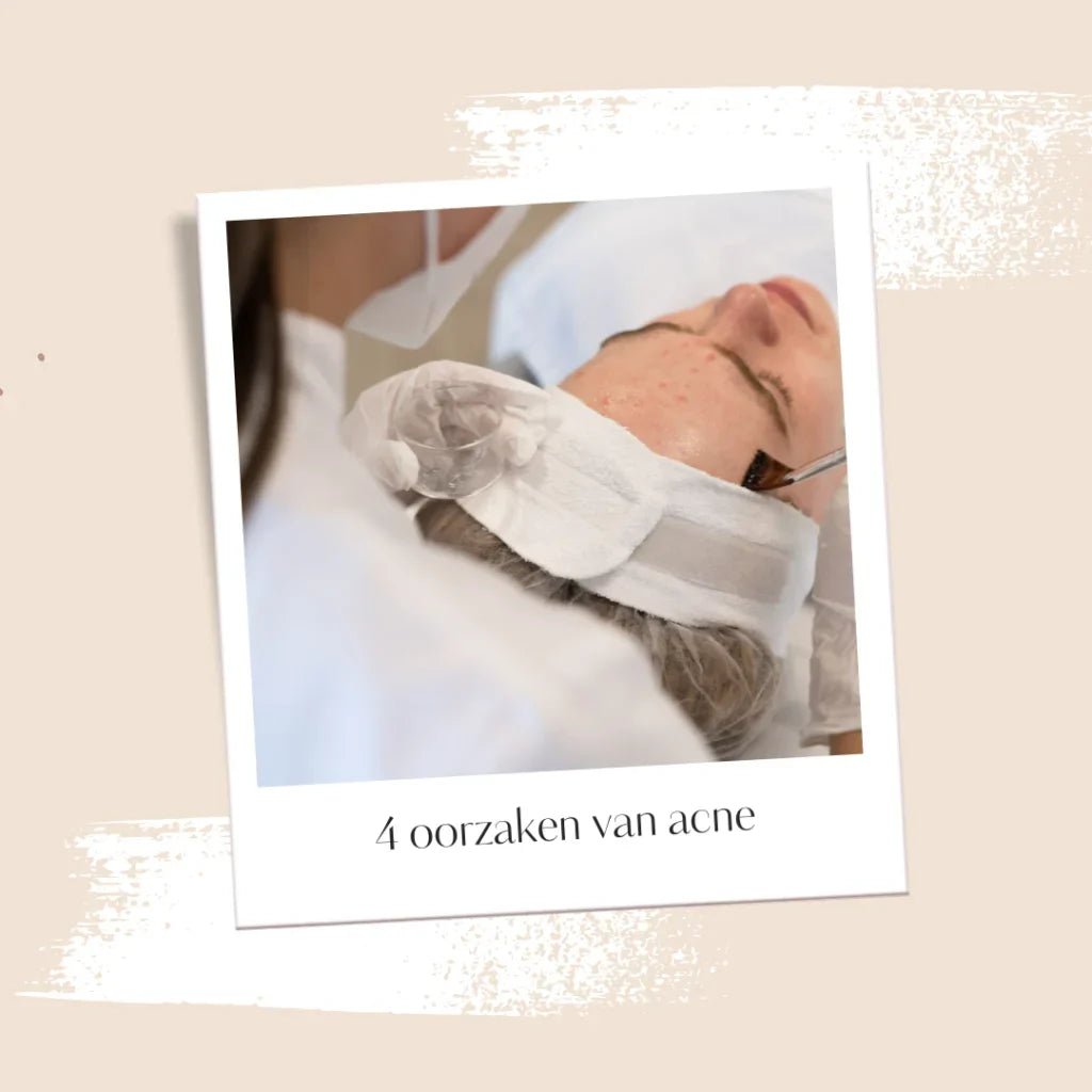 4 oorzaken van acne