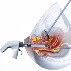 Positieve ervaring vaginale laserbehandeling