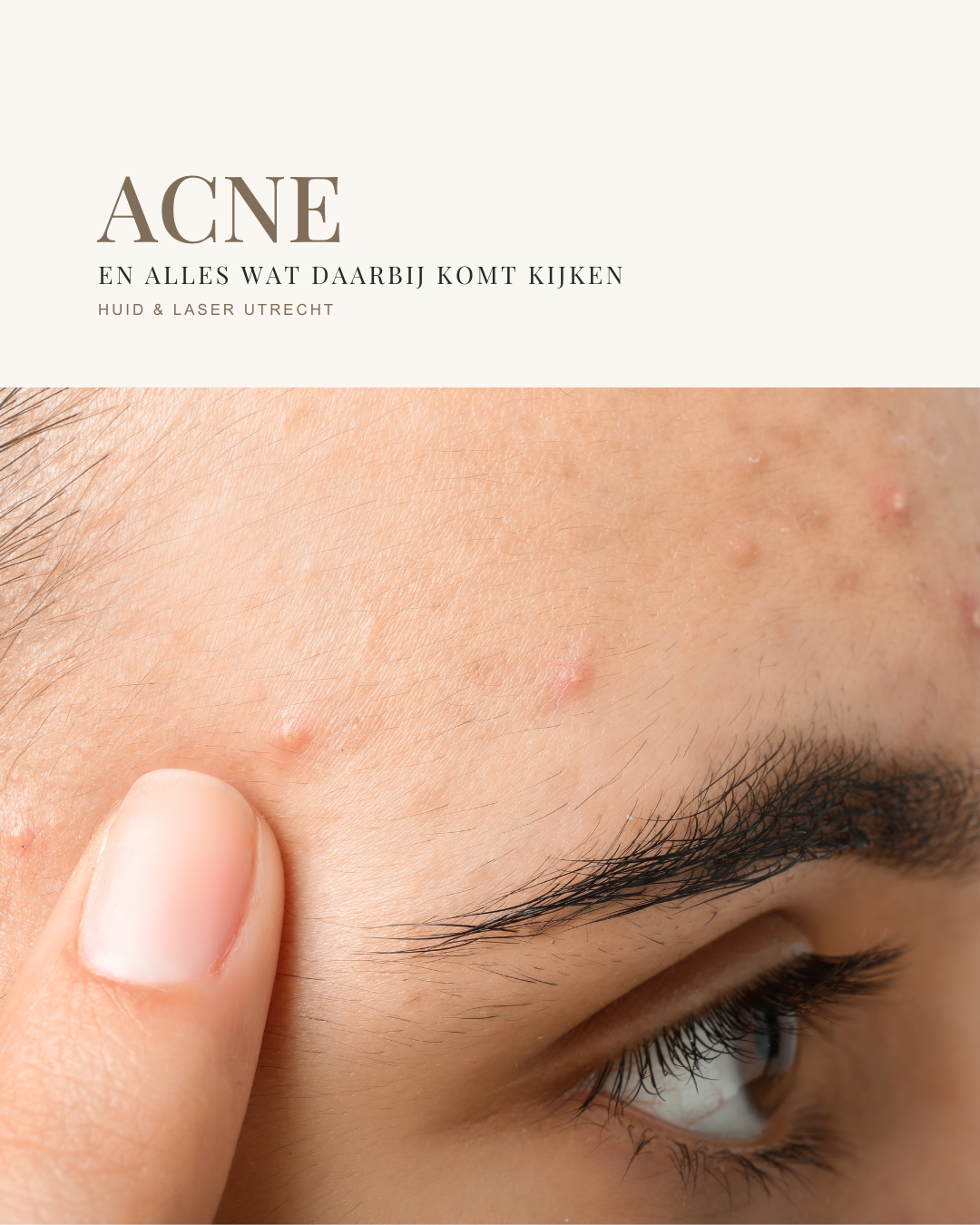 E-book Acne
